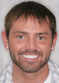 Man with bright smile from dental veneers